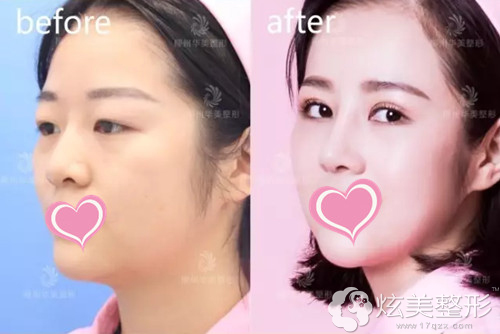 胡凯院长为我做的双眼皮和鼻子前后对比 胡凯院长为我做的双眼皮和鼻子前后对比