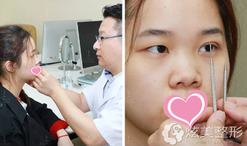 曹孟君医生为我设计双眼皮和鼻综合方案 曹孟君医生为我设计双眼皮和鼻综合方案