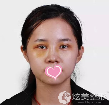 术后7天拆完线的样子 术后7天拆线后的样子