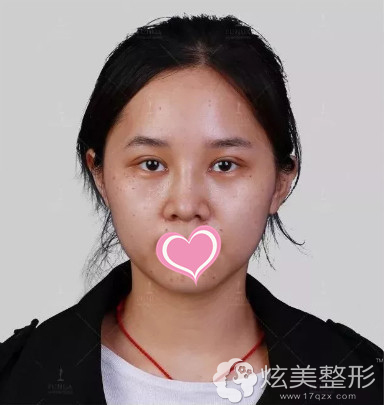 做完手术15天眼睛和鼻子慢慢恢复中 做完手术15天眼睛和鼻子慢慢恢复中