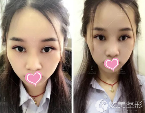 术后25天眼睛和鼻子恢复自然 术后25天眼睛和鼻子恢复自然