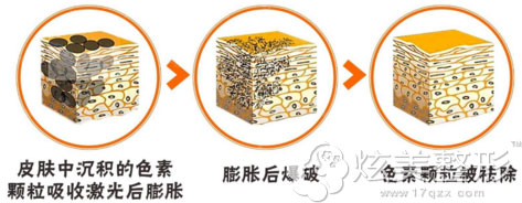 激光祛斑原理图 激光祛斑原理图