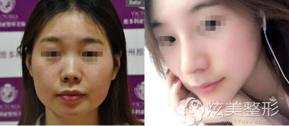 隆鼻案例台州维多利亚 隆鼻案例台州维多利亚