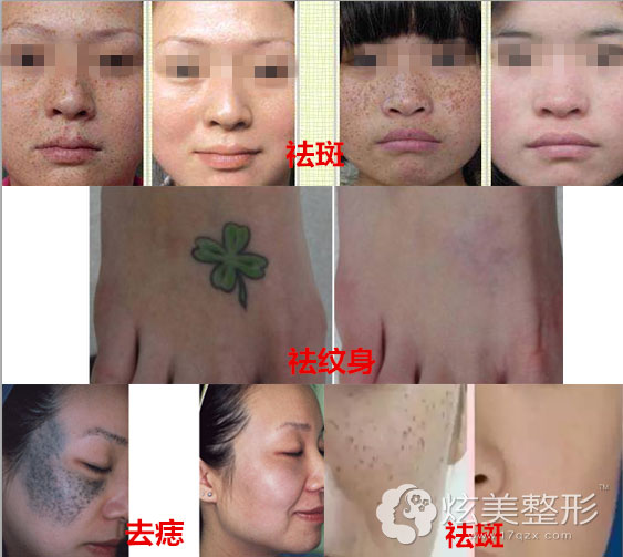 北京叶美人真人案例祛斑 北京叶美人真人案例祛斑