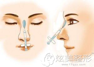 自体脂肪填充鼻子不能过量 自体脂肪填充鼻子不能过量