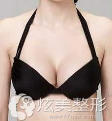 假体隆胸案例术后效果保定京都整形 假体隆胸案例术后效果保定京都