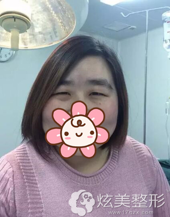 郑州瑞亚贺洁院长给又小又肉的眯缝眼做眼综合手术全过程