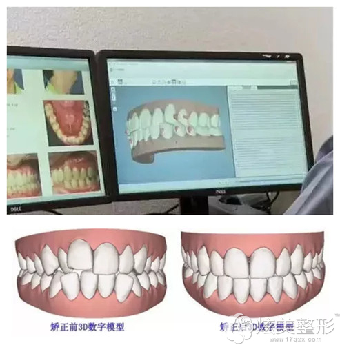 量身定制的隐适美3D矫正技术 量身定制的隐适美3D矫正技术
