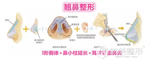 深圳希思鼻综合整形过程 深圳希思鼻综合整形过程