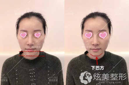 玻尿酸填充前是短下巴 玻尿酸填充前是短下巴