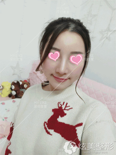 玻尿酸填充3天后拥有小V脸 玻尿酸填充3天后拥有小V脸