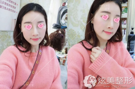 注射玻尿酸7天后面部饱满自然 注射玻尿酸7天后面部饱满自然