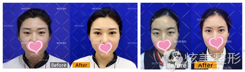 扬州施尔美整形双眼皮案例 扬州施尔美整形双眼皮案例