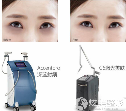 在北京凯润婷治疗黑眼圈案例及仪器 在北京凯润婷治疗黑眼圈案例及仪器