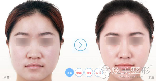 中山美南华隆鼻案例 中山美南华隆鼻案例