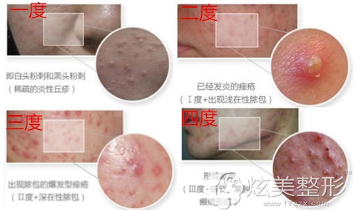 分层祛痘包头叶子 分层祛痘包头叶子