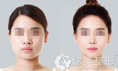 蚌埠美莱坞瘦脸真人案例 蚌埠美莱坞瘦脸真人案例
