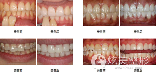 合肥贝杰口腔牙齿冷光美白真人案例 合肥贝杰口腔牙齿冷光美白真人案例
