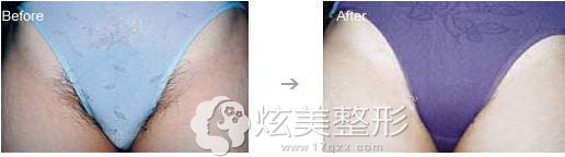 南京韩辰激光脱毛真人案例 南京韩辰激光脱毛真人案例