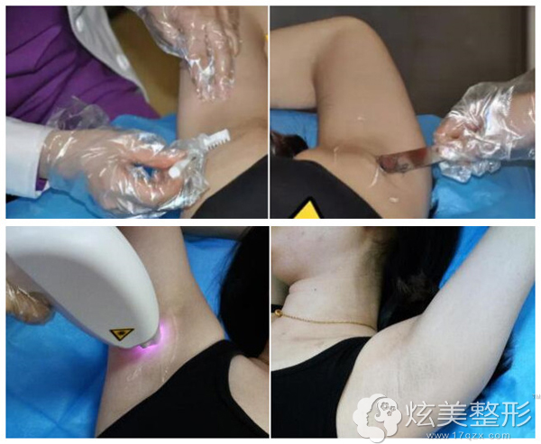 冰点脱毛过程中 冰点脱毛过程中