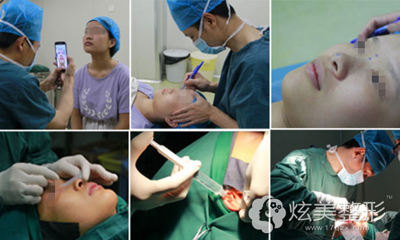 南昌佳美张效恩院长隆鼻手术过程 南昌佳美张效恩院长隆鼻手术过程