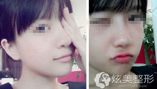 硅胶假体隆鼻+耳软骨鼻尖术后1个月效果南昌佳美 硅胶假体隆鼻+耳软骨鼻尖术后1个月效果南昌佳美