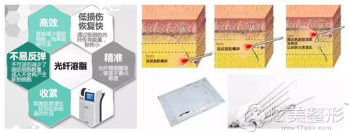 光纤溶脂瘦脸技术原理 光纤溶脂瘦脸技术原理