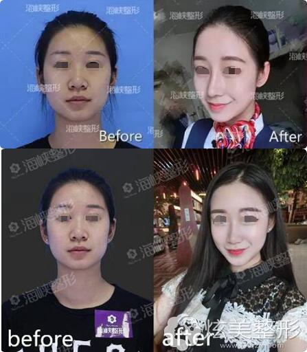 鼻综合术前术后对比案例 鼻综合术前术后对比案例