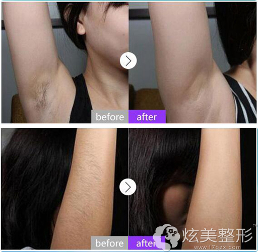 在宜春韩美脱毛案例 在宜春韩美脱毛案例