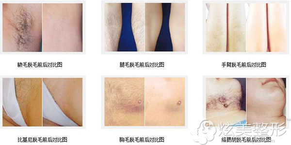 在宜春天泽冰点脱毛案例 在宜春天泽冰点脱毛案例