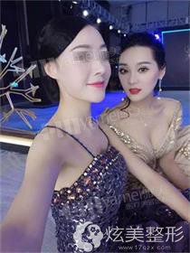 隆胸术后恢复合照 隆胸术后恢复合照