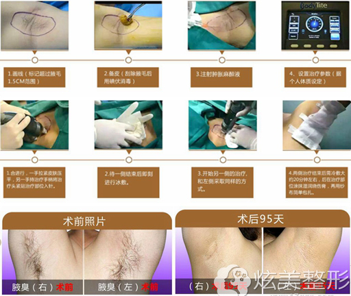 黄金微针去腋臭手术过程 黄金微针去腋臭手术过程