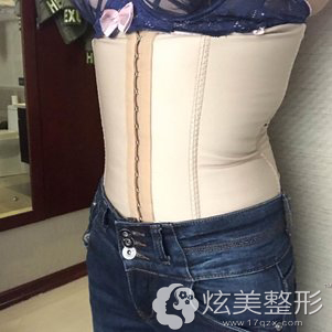 术后3天坚持穿塑身衣 术后3天坚持穿塑身衣