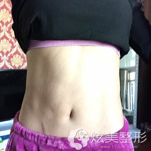 做完吸脂术后25天肚子慢慢恢复中 做完吸脂术后25天肚子慢慢恢复中