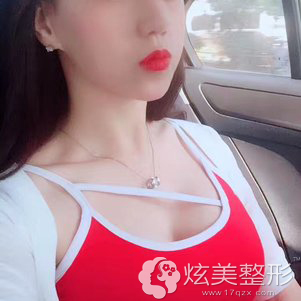 术后2个月胸部恢复自然 术后2个月胸部恢复自然
