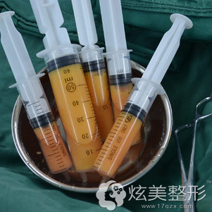 填充面部的自体脂肪 填充面部的自体脂肪