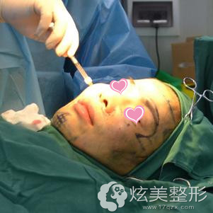 李科医生为我做自体脂肪填充 李科医生为我做自体脂肪填充