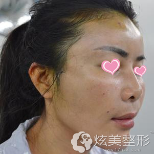 刚做完手术面部肿胀 刚做完手术面部肿胀