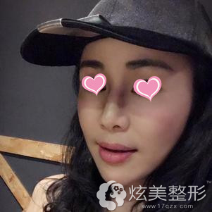 术后7天面部消肿中 术后7天面部消肿中
