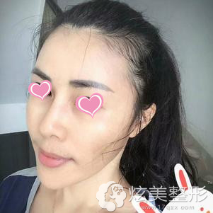 术后2个月面部呈现小V脸 术后2个月面部呈现小V脸