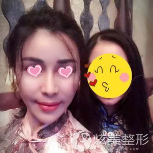 恢复25天后面部饱满立体 恢复25天后面部饱满立体