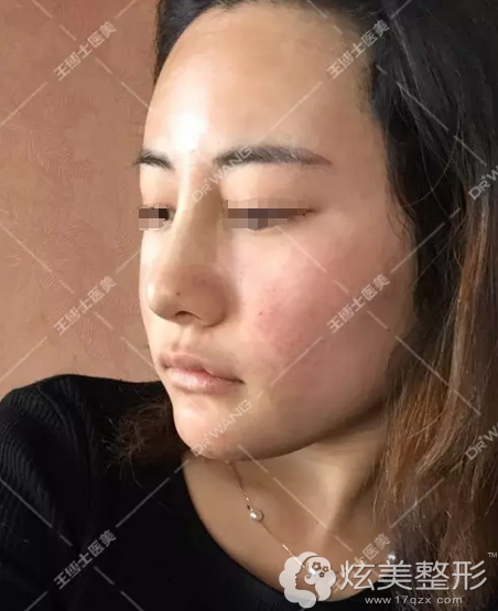 94妹纸在青岛王博士做了韩式生科假体隆鼻来看蜕变大不