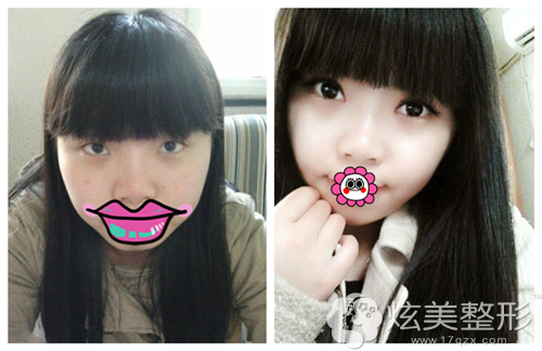 在醴陵华美做眼综合仅22天内双小妞就拥有一双芭比大眼