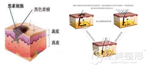 马鞍山福华整形医院激光点痣原理 马鞍山福华整形医院激光点痣原理