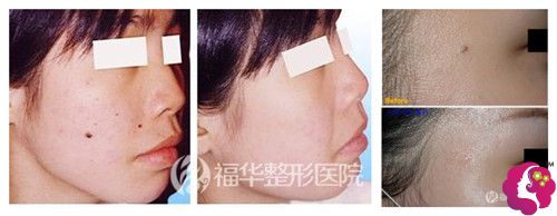 马鞍山福华激光点痣案例 马鞍山福华激光点痣案例