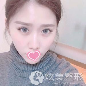 术后1个月双眼皮恢复自然 术后1个月双眼皮恢复自然