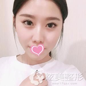 25天后双眼皮完全消肿 25天后双眼皮完全消肿