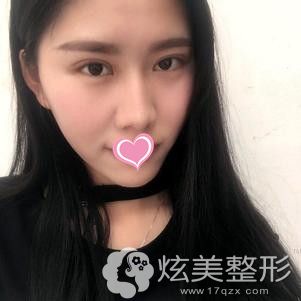 15天后眼睛恢复情况 15天后眼睛恢复情况