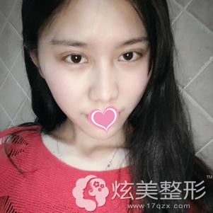 双眼皮手术7天后拆线的样子 双眼皮手术7天后拆线的样子