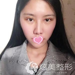 术后3天眼睛消肿不少 术后3天眼睛消肿不少